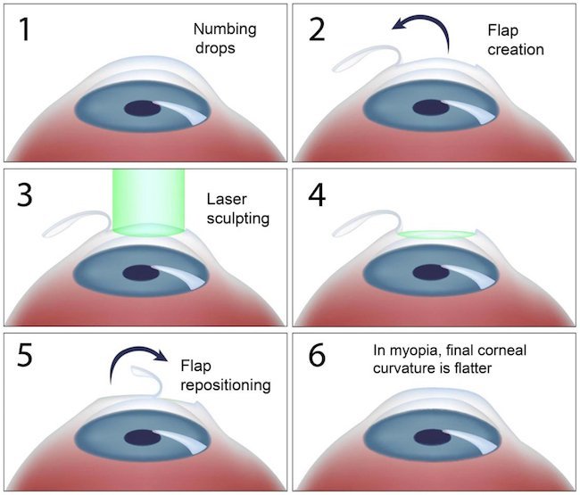 LASIK Refractive Eye Surgery