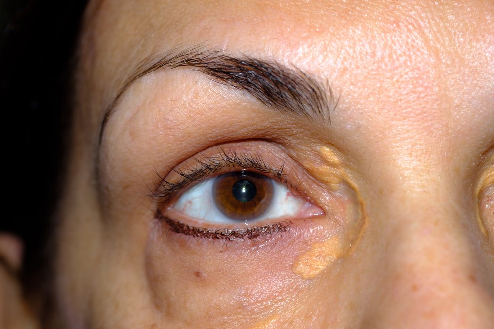 Xantelasma Palpebrale. Cause E Cura. - The Eye News