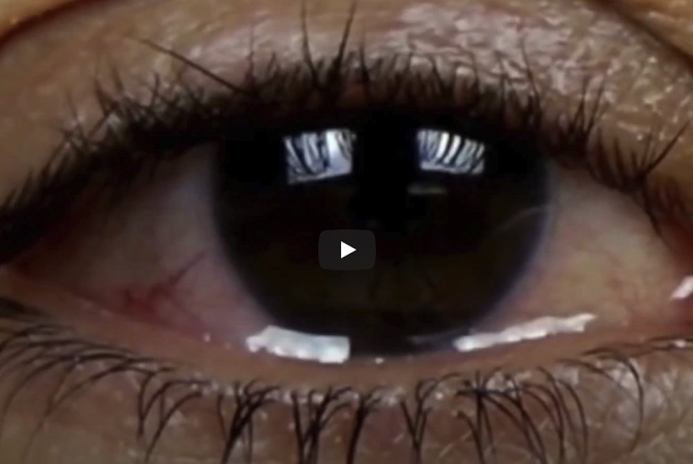 Cos’è la chirurgia refrattiva oculare